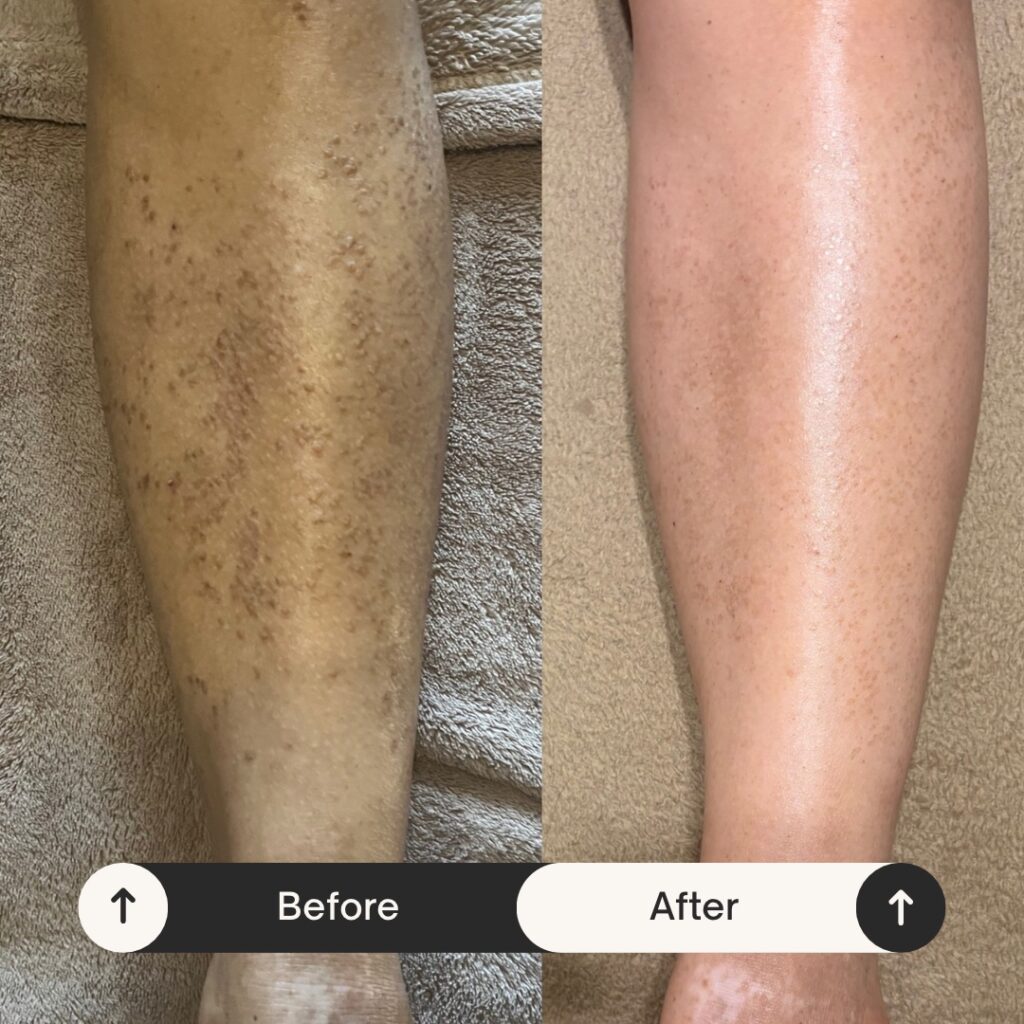 施術から2年半（毎月2回施術）