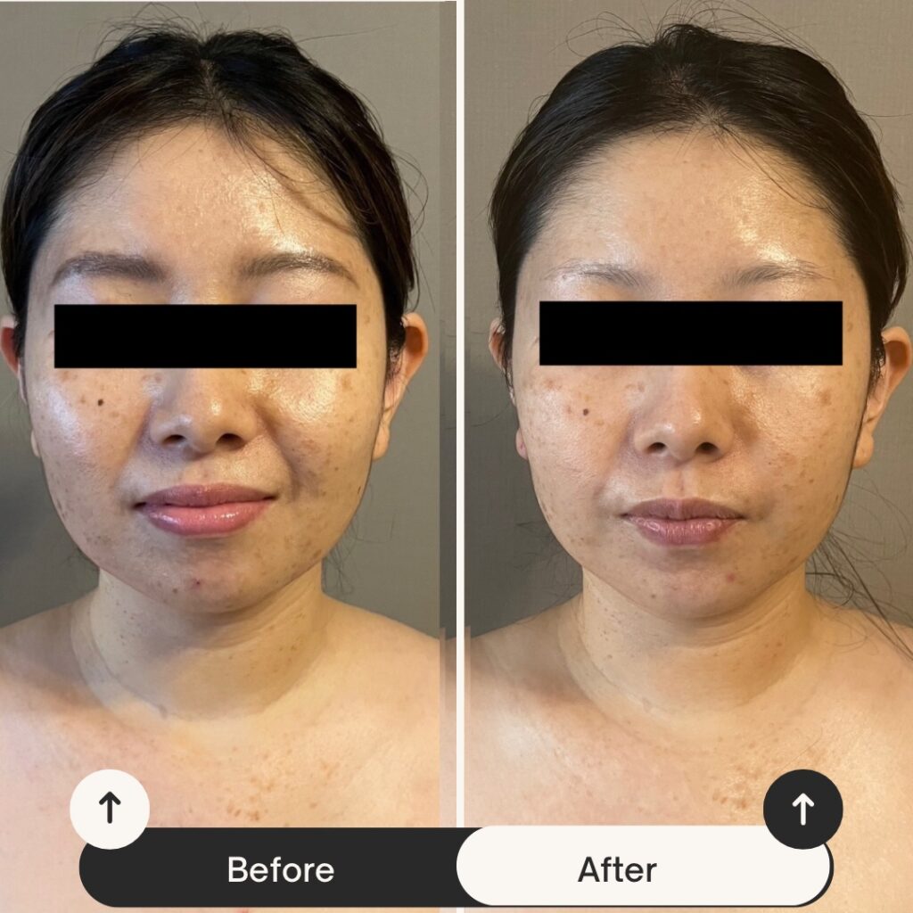 施術４回の結果